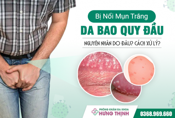 Da Bao Quy Đầu Bị Nổi Mụn Trắng Nguyên Nhân Do Đâu? Làm Thế Nào Để Xử Lý?