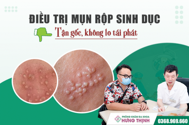 Điều trị mụn rộp sinh dục tận gốc, không lo tái phát