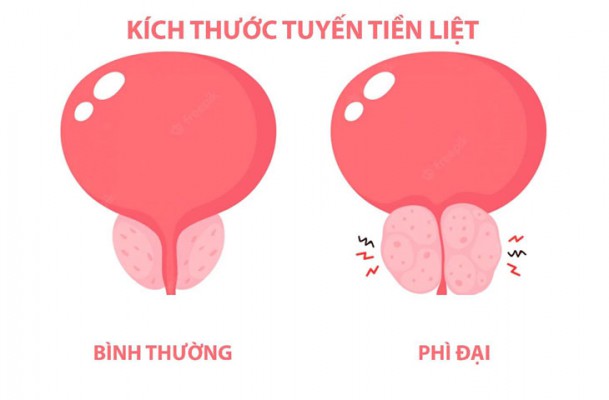 Phì đại tuyến tiền liệt là gì? Điều trị như thế nào để tránh biến chứng?