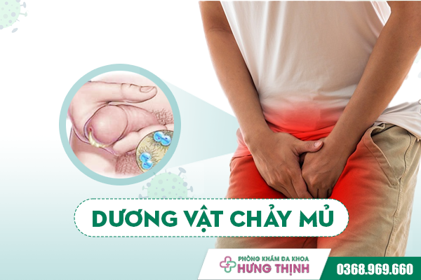 Dương vật chảy mủ - Dấu hiệu của nhiều bệnh “khó nói”