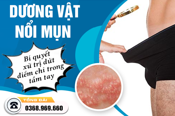 Dương vật nổi mụn? Đừng lo! Bí quyết xử trị dứt điểm chỉ trong tầm tay 