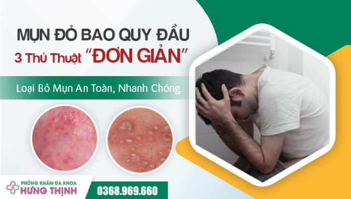 Mụn Đỏ Bao Quy Đầu Là Bệnh Gì? 3 Thủ Thuật Đơn Giản Loại Bỏ Mụn An Toàn, Nhanh Chóng