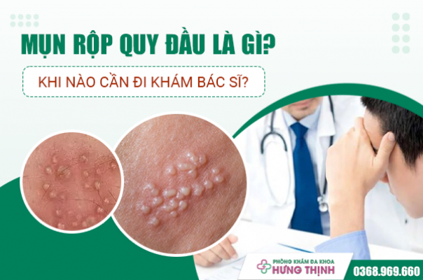  Mụn Rộp Quy Đầu Là Gì? Khi Nào Cần Đi Khám Bác Sĩ?