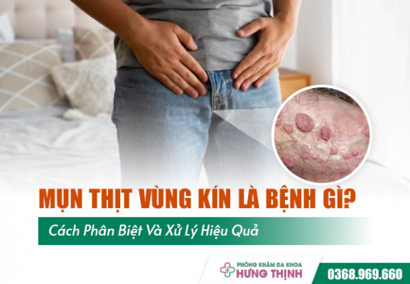 Mụn Thịt Vùng Kín Là Bệnh Gì? Cách Phân Biệt Và Xử Lý Hiệu Quả