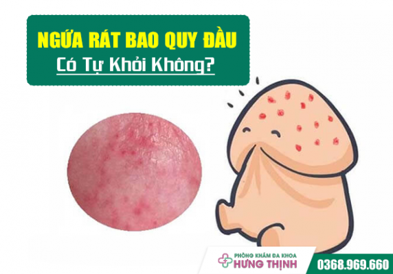 Ngứa Rát Bao Quy Đầu Có Tự Khỏi Không? Tiết Lộ 5 Bệnh Lý Thường Gặp Gây Ra