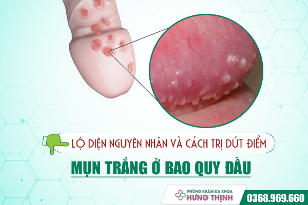 Lộ diện nguyên nhân và cách trị dứt điểm mụn trắng ở bao quy đầu