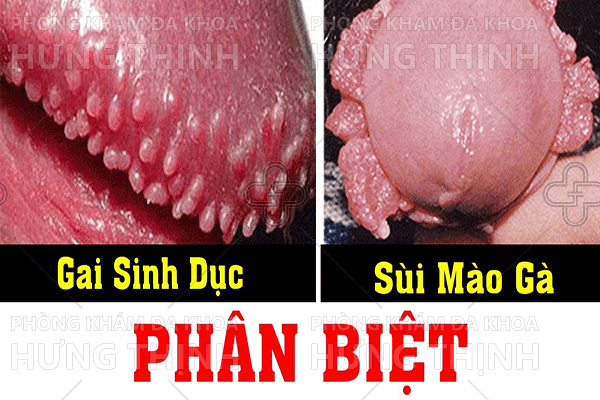 Phân biệt sùi mào gà và gai sinh dục