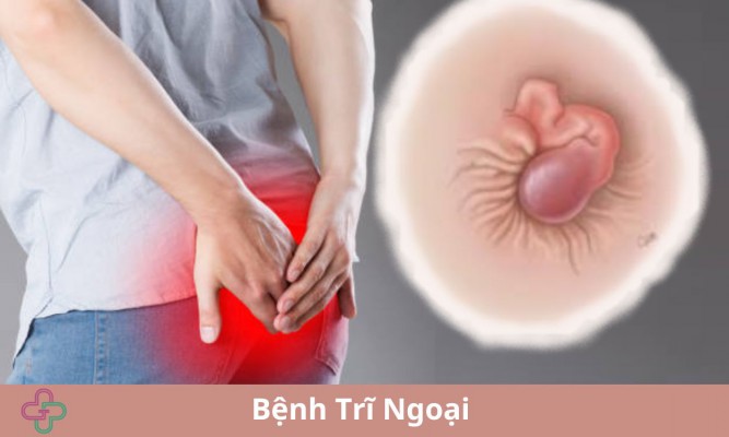 Giải đáp thông tin về bệnh trĩ ngoại - triệu chứng, phương pháp điều trị hiệu quả hiện nay