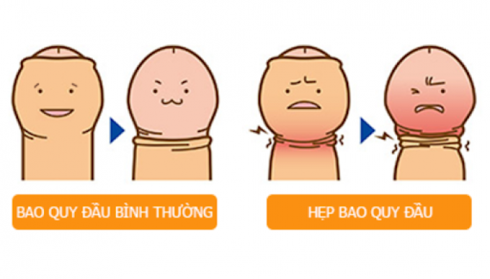 Nhận biết bệnh lý hẹp bao quy đầu - Có nên cắt bao quy đầu không?