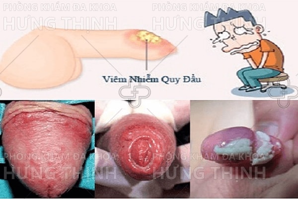 Dương vật nổi mụn là dấu hiệu bệnh gì?