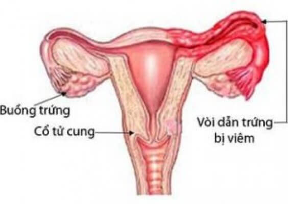 Bệnh viêm ống dẫn trứng: triệu chứng, nguyên nhân và cách điều trị