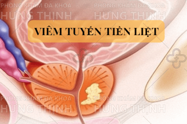 Triệu chứng bệnh viêm tuyến tiền liệt nam giới nên biết