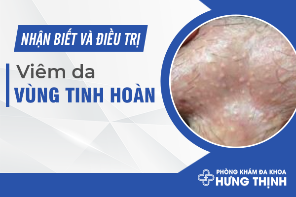 Nhận Biết Và Điều Trị Viêm Da Vùng Tinh Hoàn