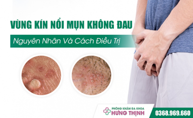 Vùng Kín Nổi Mụn Không Đau Là Bệnh Gì? Nguyên Nhân Và Cách Điều Trị